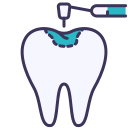 remplissage des dents