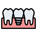 implant dentystyczny