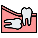 Wisdom tooth